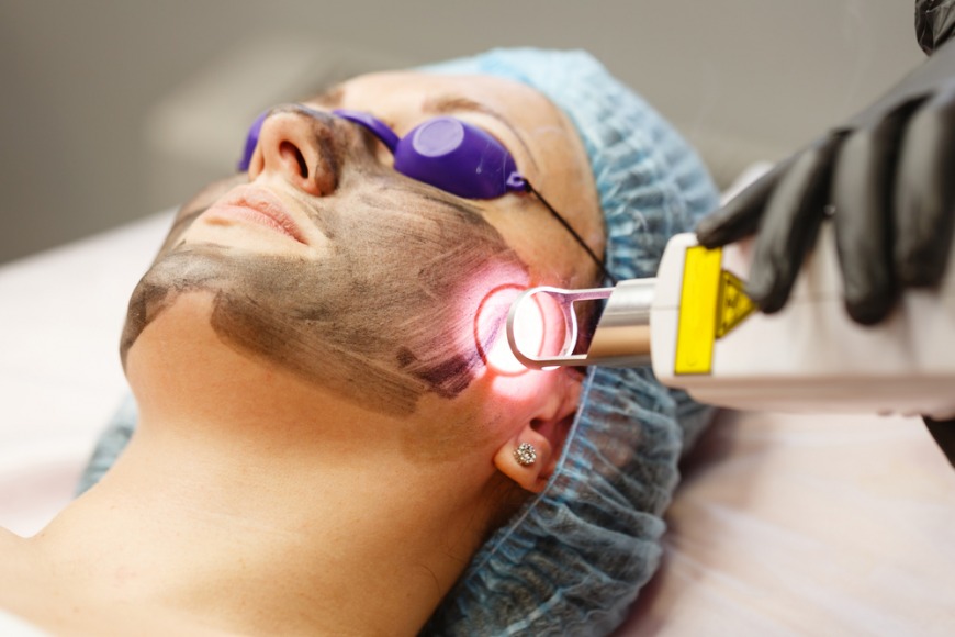 Carbon laser peel offers in Dubai Carbon laser peel offers in Dubai